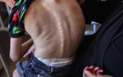 Nearly 12,000 children under five in Gaza face acute malnutrition, WHO reports