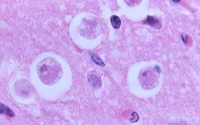 Brain-eating amoeba kills 19 in India